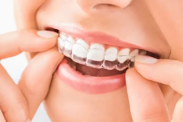 Aligners Cost in India